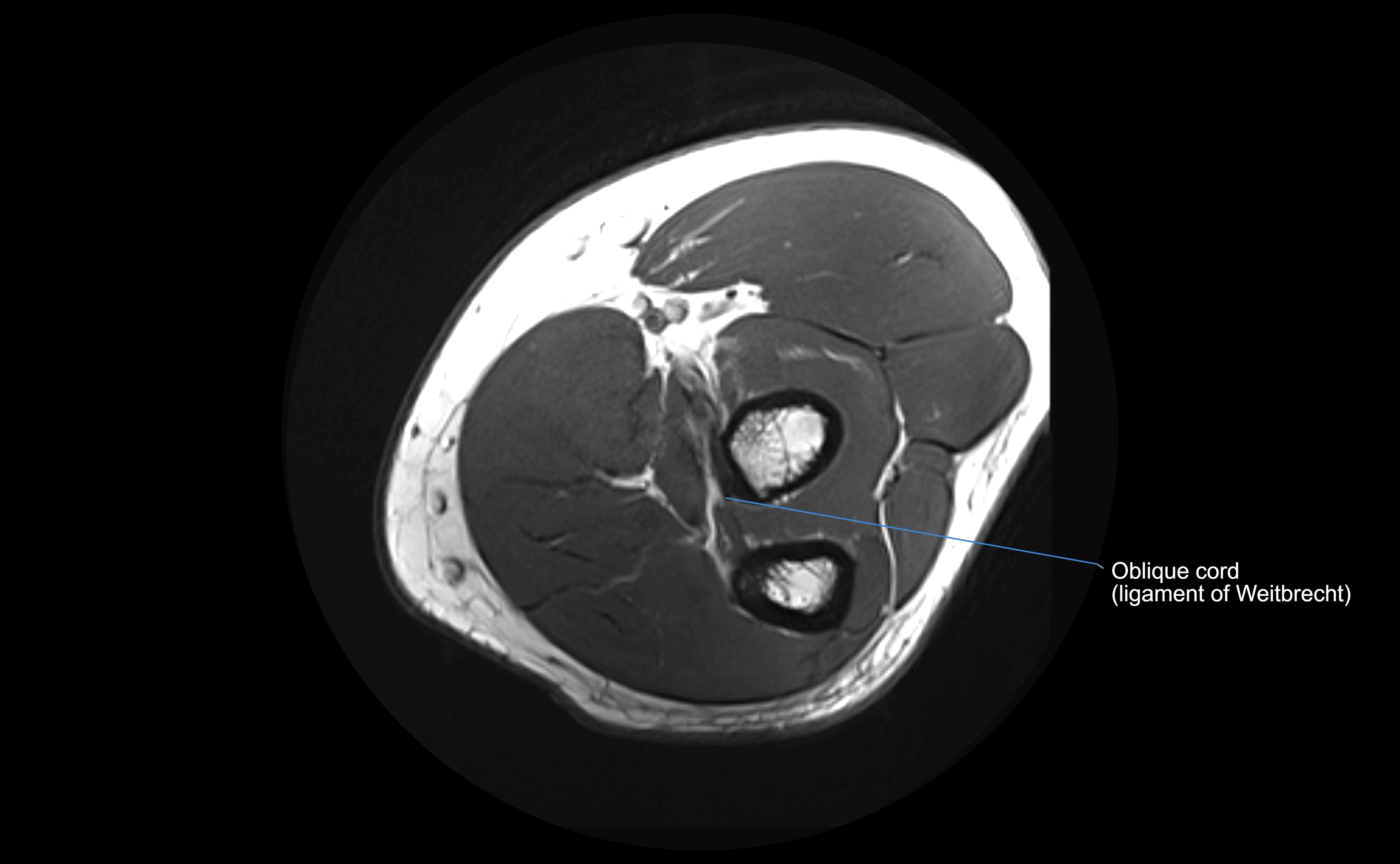 MRI elbow ligaments axial cross sectional anatomy 3T  radiology  image-img-00001-00025.webp